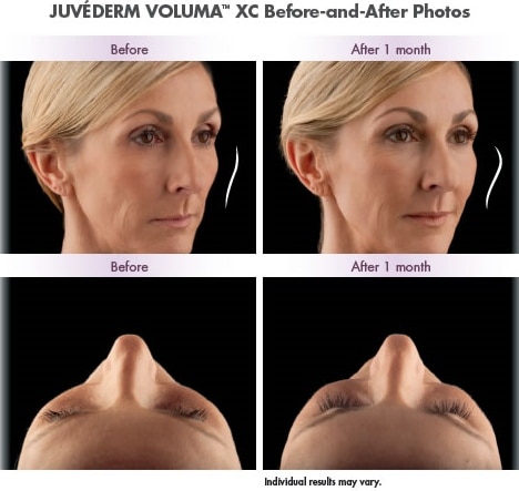 Before & After Juvederm treatment at Williamsburg Plastic Surgery, Williamsburg, VA