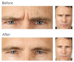 Before and After Botox Treatment 2 | Williamsburg VA