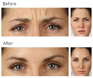 Before and After Botox Treatment | Williamsburg VA
