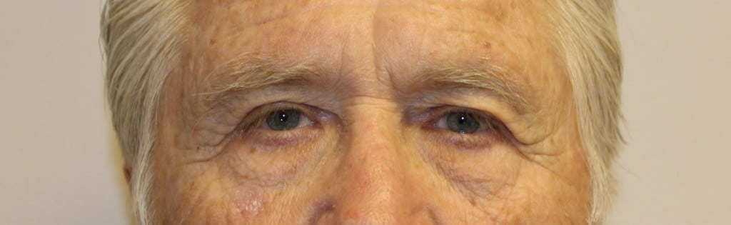 Eyelid Surgery Williamsburg VA | Blepharoplasty