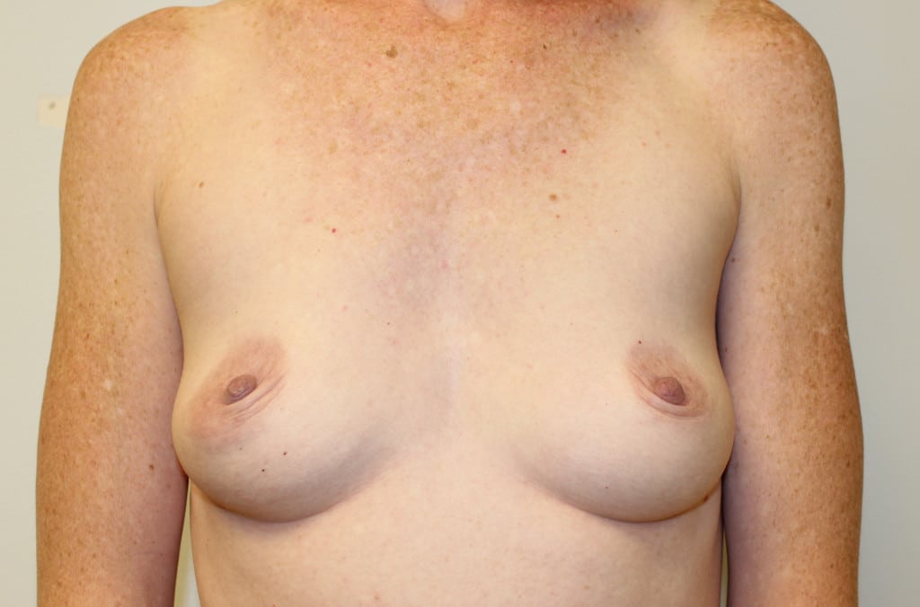 Before Reconstructive Breast Surgery
