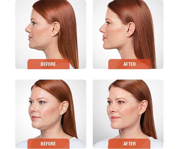 Kybella | Before and After | Williamsburg Plastic Surgery